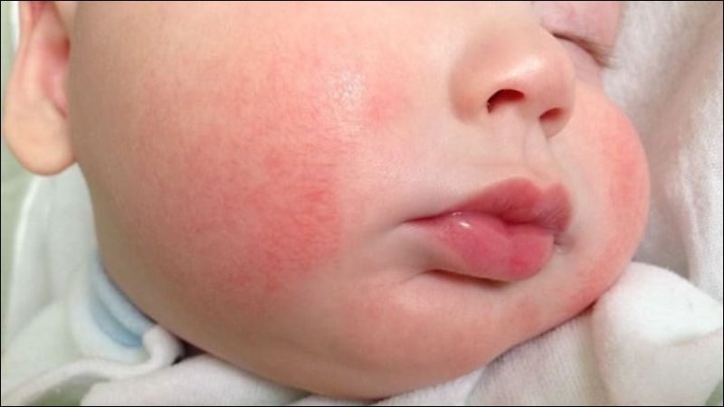 Viêm da cơ địa ở trẻ em thường xuất hiện đầu tiên ở má và trán hoặc da đầu