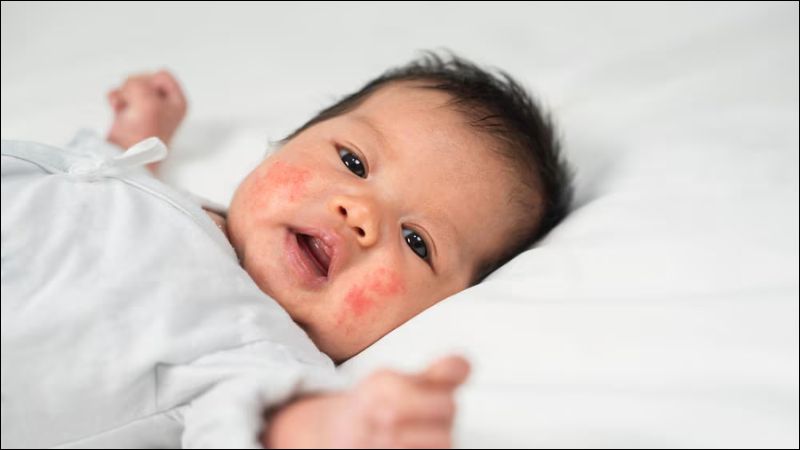 Viêm da cơ địa không phải là bệnh truyền nhiễm và không thể lây