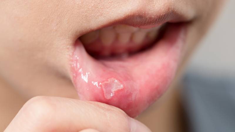 Nhiệt miệng liên tục có thể do cơ thể thiếu hụt các vitamin