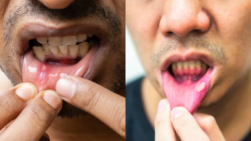 Viêm loét miệng có thể gặp các kích thước khác nhau