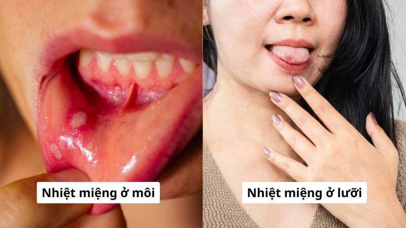 Nhiệt miệng có thể xuất hiện ở nhiều vị trí trong khoang miệng