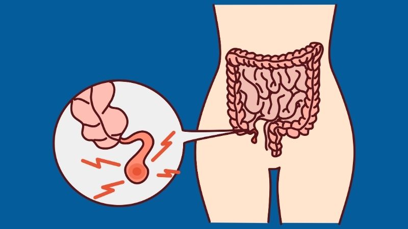 Tắc nghẽn trong niêm mạc ruột thừa là nguyên nhân chủ yếu gây viêm ruột thừa