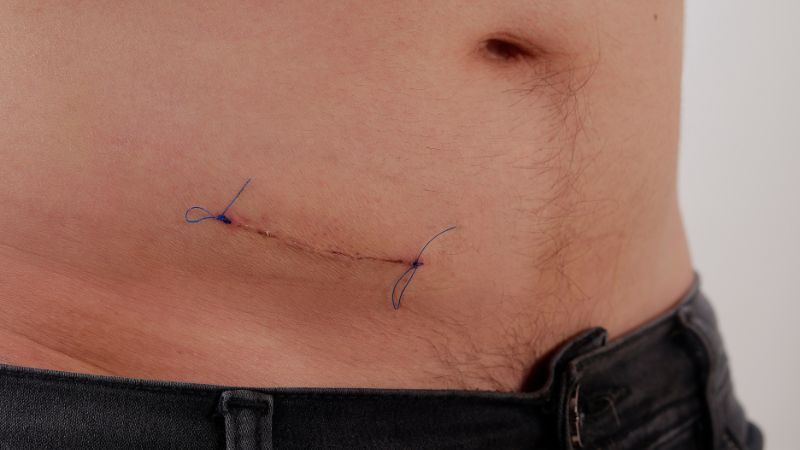 Thời gian hồi phục sau mổ ruột thừa có thể dài hơn ở người lớn tuổi