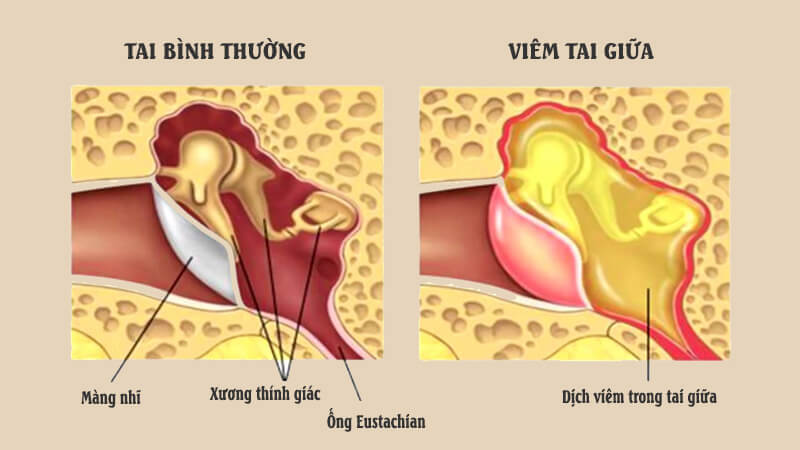 Viêm tai giữa là tình trạng viêm, ứ dịch ở niêm mạc tai giữa Viêm tai giữa là tình trạng viêm, ứ dịch ở niêm mạc tai giữa