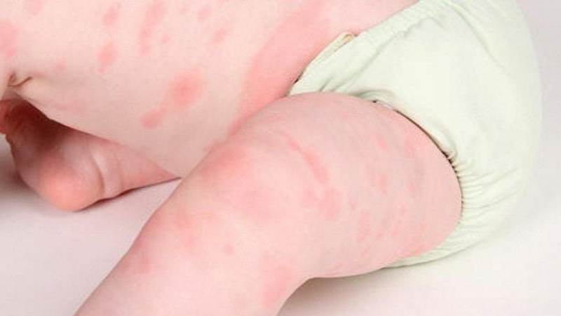 Trẻ em là đối tượng dễ xuất hiện mề đay