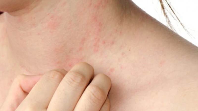 Nổi mề đay không phải là bệnh lây nhiễm