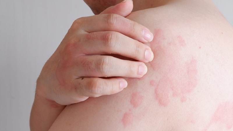 Mề đay thường xuất hiện các nốt sẩn đa hình dạng trên da với màu hồng hơn bình thường