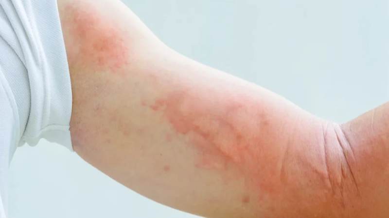 Thông thường, nổi mề đay sẽ tự khỏi trong vòng một ngày