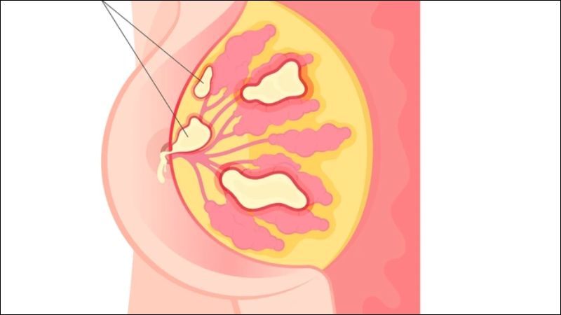 Áp xe vú là tình trạng tích tụ mủ bên trong mô vú do nhiễm trùng