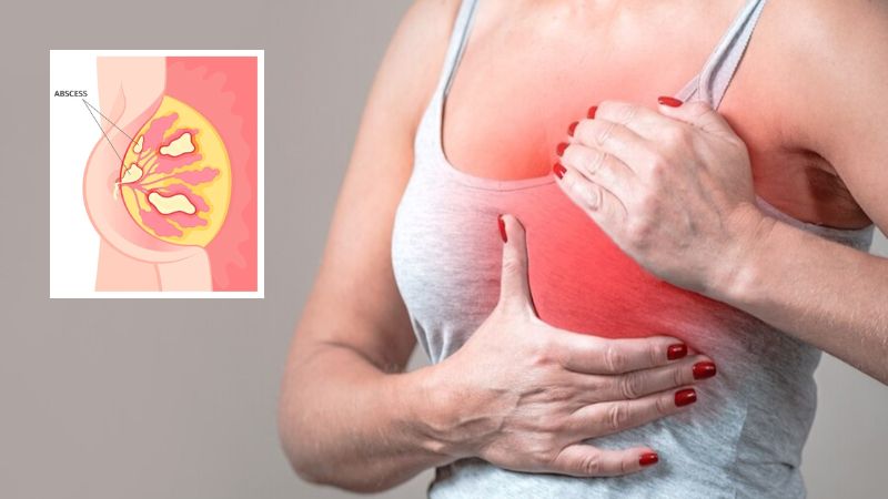 Sưng tấy, nóng, đỏ, đau vùng vú là triệu chứng điển hình khi bị áp xe vú