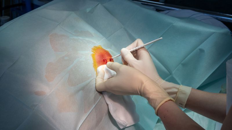 Tiểu phẫu dẫn lưu mủ là phương pháp điều trị áp xe vú