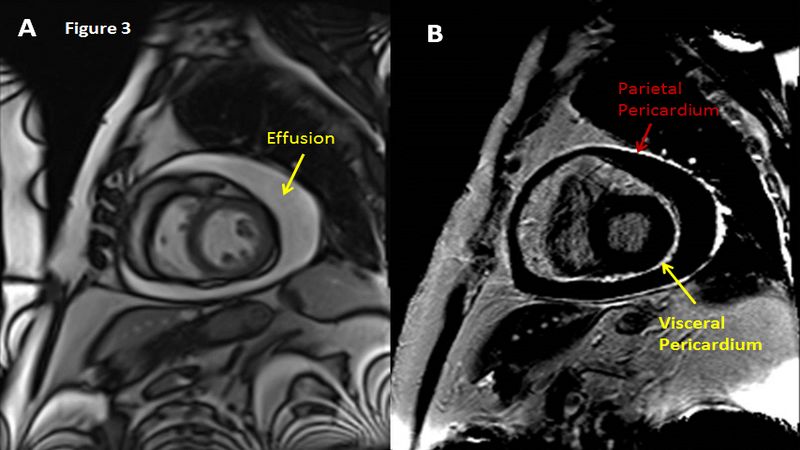 Chụp MRI tim giúp đánh giá tình trạng tràn dịch màng ngoài tim hiệu quả Chụp MRI tim giúp đánh giá tình trạng tràn dịch màng ngoài tim hiệu quả