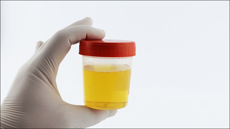 Xét nghiệm nước tiểu giúp đánh giá có tổn thương thận hay không.