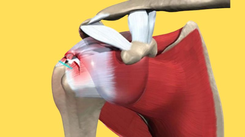 Hội chứng chóp xoay vai thường gặp do tổn thương gân và các cấu trúc vai Hội chứng chóp xoay vai thường gặp do tổn thương gân và các cấu trúc vai