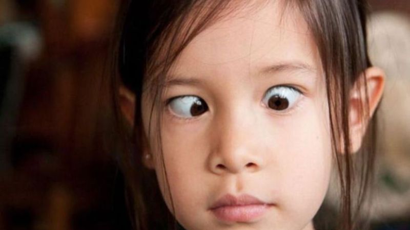 Mắt lác có thể dẫn tới nhược thị Mắt lác có thể dẫn tới nhược thị