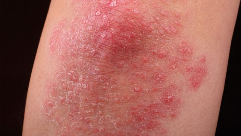 Lichen phẳng điển hình thường là các tổn thương sẩn, mảng có màu tím hoặc đỏ Lichen phẳng điển hình thường là các tổn thương sẩn, mảng có màu tím hoặc đỏ