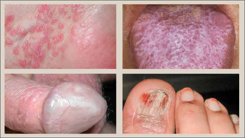 Triệu chứng của bệnh lichen phẳng đa dạng và phụ thuộc vào vị trí tổn thương Triệu chứng của bệnh lichen phẳng đa dạng và phụ thuộc vào vị trí tổn thương