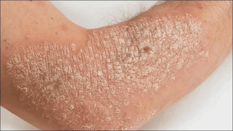 Lichen phẳng là một tổn thương lành tính và ít có nguy cơ ác tính hóa Lichen phẳng là một tổn thương lành tính và ít có nguy cơ ác tính hóa