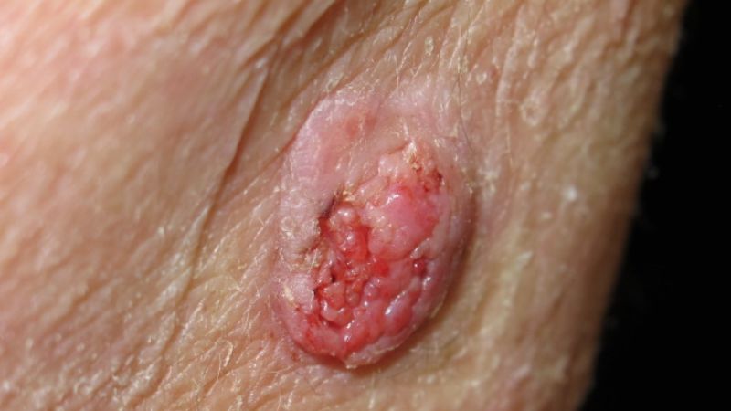 Bạn nên đến gặp bác sĩ nếu các tổn thương cũ lớn dần có vết loét, bờ dày lên Bạn nên đến gặp bác sĩ nếu các tổn thương cũ lớn dần có vết loét, bờ dày lên