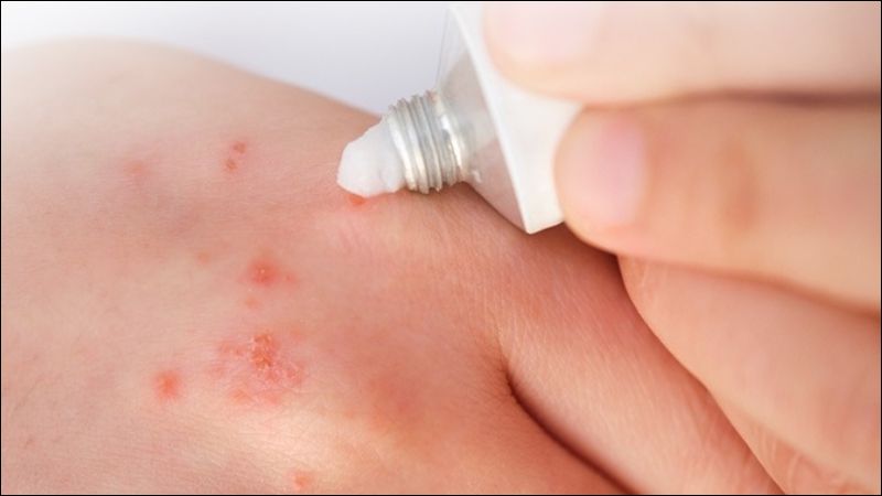 Thuốc bôi corticosteroid có thể làm giảm tình trạng viêm của tổn thương Thuốc bôi corticosteroid có thể làm giảm tình trạng viêm của tổn thương