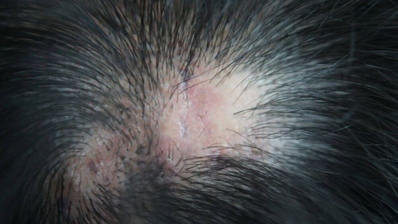 Lichen phẳng nang lông có thể gây rụng lông, tóc Lichen phẳng nang lông có thể gây rụng lông, tóc
