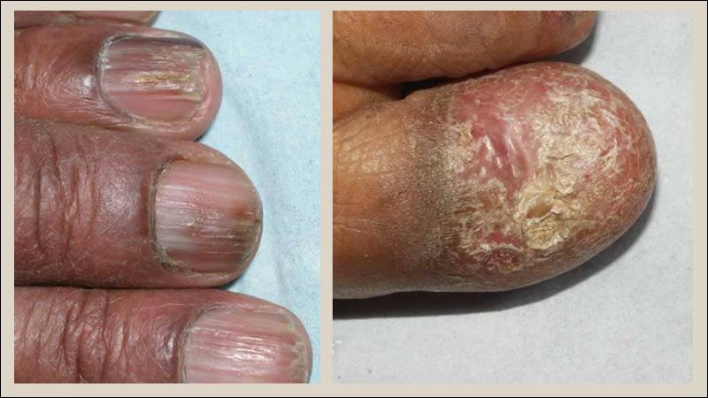 Móng có thể xuất hiện các đường rãnh, gờ sọc trong Lichen phẳng ở móng Móng có thể xuất hiện các đường rãnh, gờ sọc trong Lichen phẳng ở móng