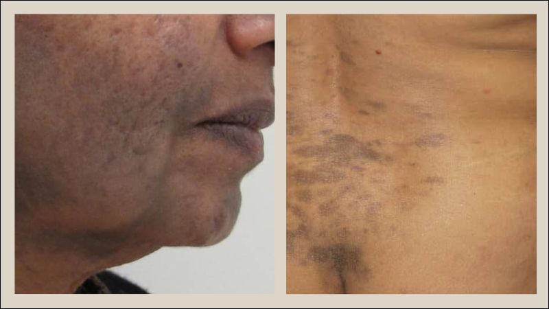 Mặt, cổ hoặc thân là các vị trí thường gặp trong Lichen phẳng sắc tố Mặt, cổ hoặc thân là các vị trí thường gặp trong Lichen phẳng sắc tố