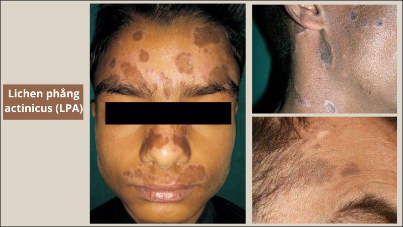 Lichen phẳng actinicus (LPA) còn được gọi là viêm da hắc tố dạng lichen Lichen phẳng actinicus (LPA) còn được gọi là viêm da hắc tố dạng lichen