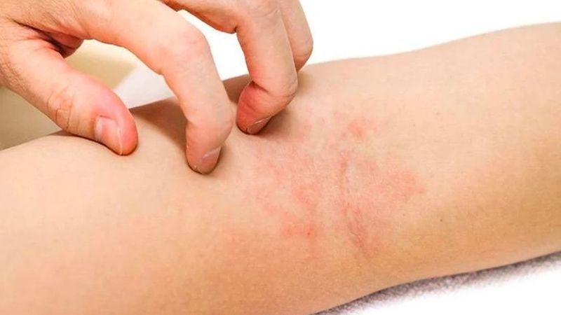 Viêm da cơ địa gây khô da, ngứa, bong tróc da Viêm da cơ địa gây khô da, ngứa, bong tróc da