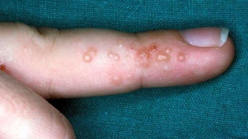 Mụn nước nhỏ li ti là dấu hiệu đặc trưng của tổ đỉa Mụn nước nhỏ li ti là dấu hiệu đặc trưng của tổ đỉa