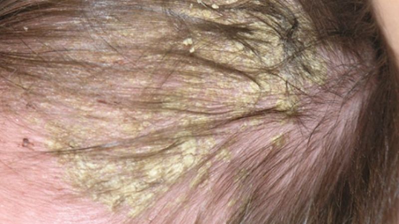 Viêm da tiết bã ở trẻ em Viêm da tiết bã ở trẻ em
