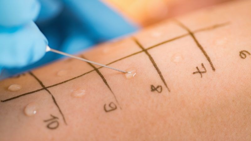 Test lẩy da để tìm các nguyên nhân gây viêm Test lẩy da để tìm các nguyên nhân gây viêm