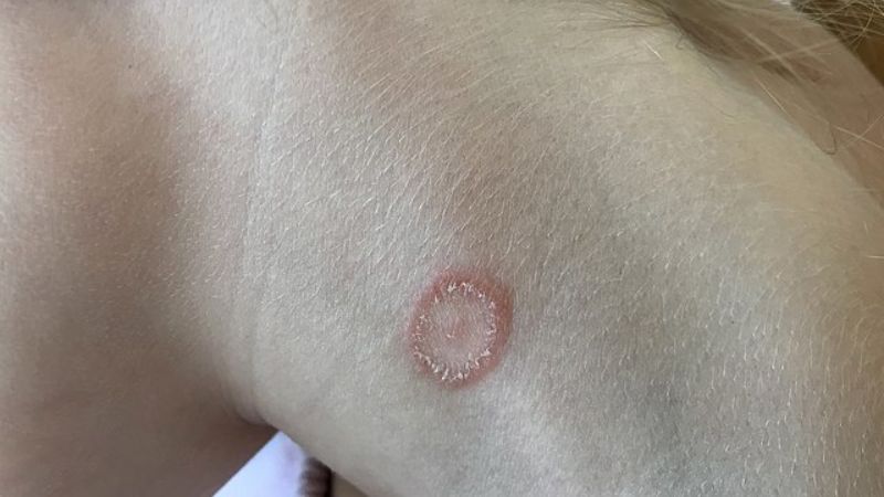 Hắc lào có thể xuất hiện trên vùng da ở vùng cổ 