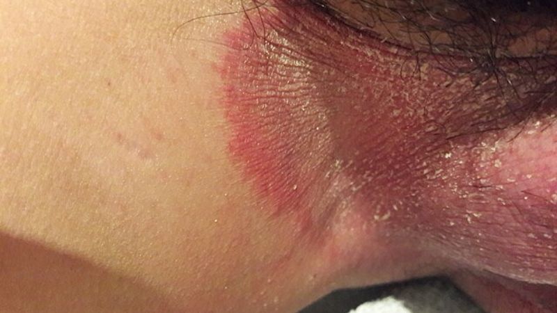 Hắc lào vùng háng xuất hiện phổ biến ở nam giới và trẻ vị thành niên
