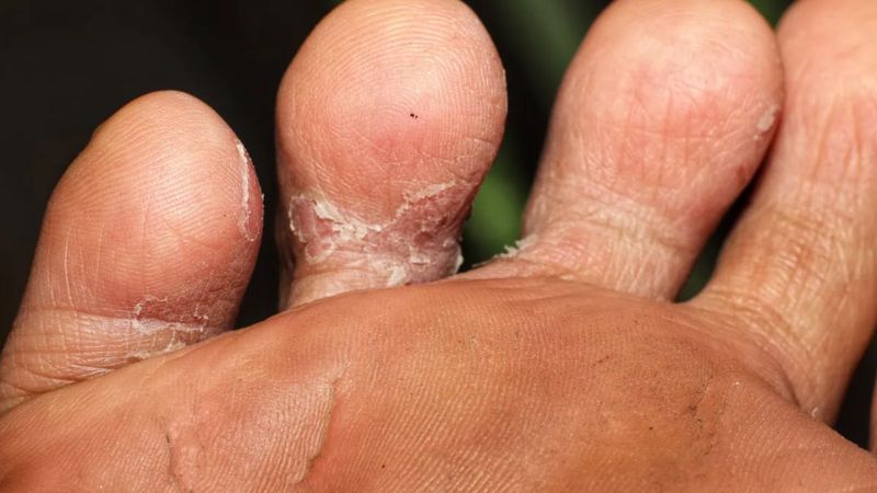 Thói quen đi chân trần làm tăng nguy cơ mắc hắc lào ở bàn chân