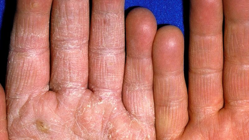 Những vết nứt sâu xuất hiện trên lòng bàn tay