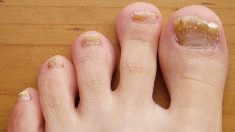 Môi trường ẩm ướt tạo điều kiện cho hắc lào vùng móng phát triển