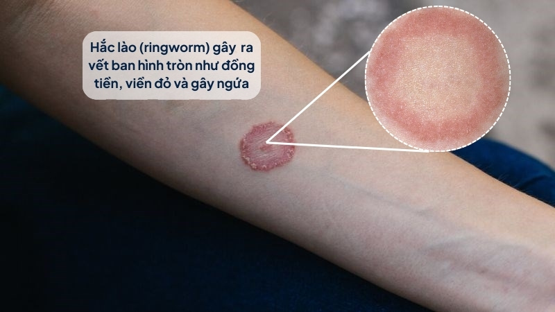 Bệnh hắc lào gây ra vết ban hình tròn như đồng tiền, viền đỏ và ngứa