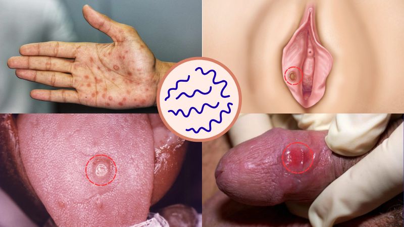 Xoắn khuẩn gây tổn thương ở nhiều bộ phận khác nhau Xoắn khuẩn gây tổn thương ở nhiều bộ phận khác nhau