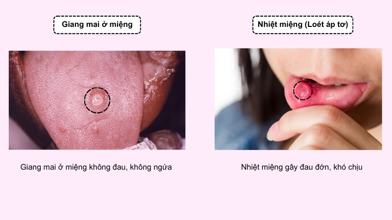 Giang mai ở miệng dễ nhầm lẫn với nhiệt miệng Giang mai ở miệng dễ nhầm lẫn với nhiệt miệng