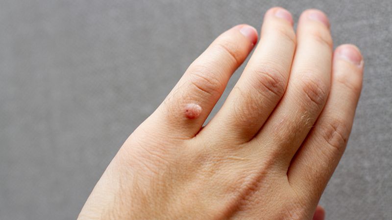Giai đoạn thứ phát, bệnh có thể hình thành mụn cóc Giai đoạn thứ phát, bệnh có thể hình thành mụn cóc