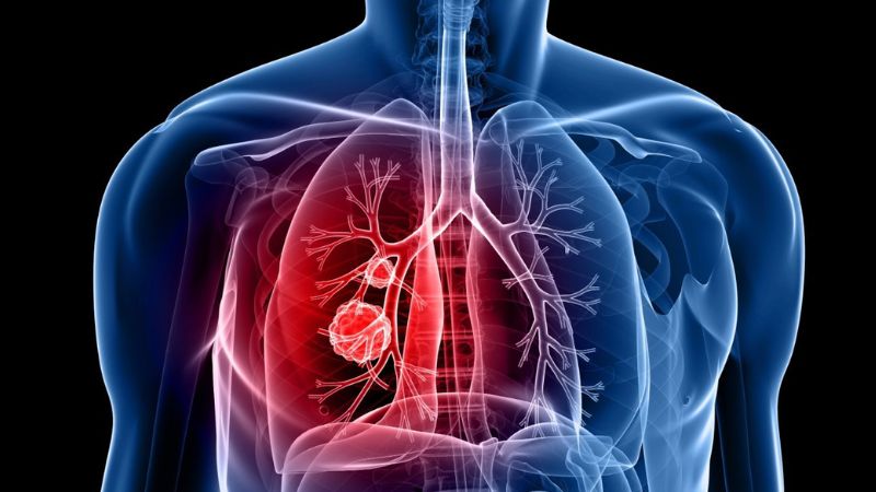 Bệnh bụi phổi Amiăng có thể gây biến chứng ung thư phổi 