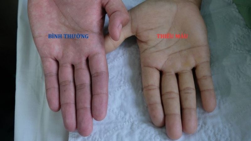 Biểu hiện thiếu máu rõ chỉ xuất hiện ở người bệnh bị nhiễm giun tóc nặng Biểu hiện thiếu máu rõ chỉ xuất hiện ở người bệnh bị nhiễm giun tóc nặng
