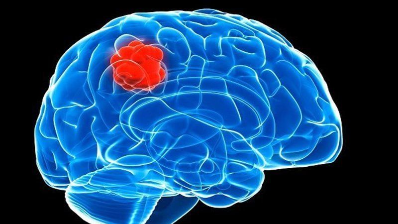 U não là một trong những nguyên nhân dẫn tới đau đầu thứ phát