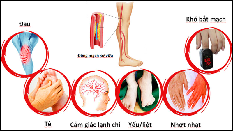 Triệu chứng của bệnh động mạch ngoại biên thường rất đa dạng