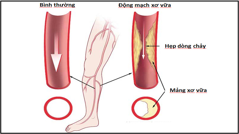 Bệnh động mạch ngoại biên có thể gây thiếu máu cục bộ chi