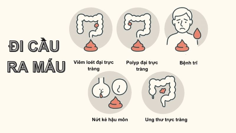 Đi cầu ra máu là dấu hiệu của nhiều bệnh lý nguy hiểm Đi cầu ra máu là dấu hiệu của nhiều bệnh lý nguy hiểm