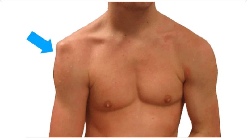Biến dạng khớp vai là một dấu hiệu của trật khớp vai  