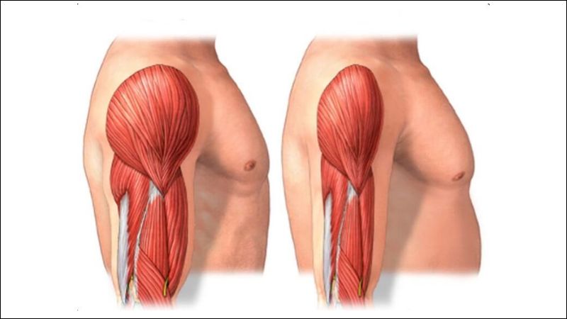 Trật khớp vai tái hồi không được điều trị có thể dẫn tới teo cơ
