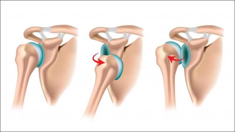 Trật khớp vai tái hồi là tình trạng trật khớp vai tái phát hay mạn tính